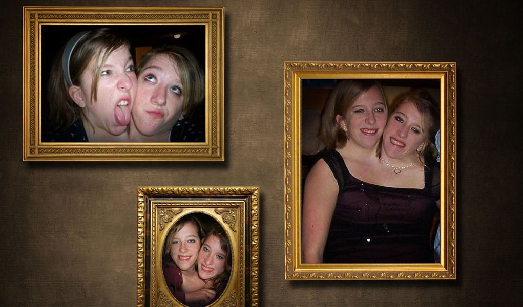 A incrível saga de duas gêmeas siamesas