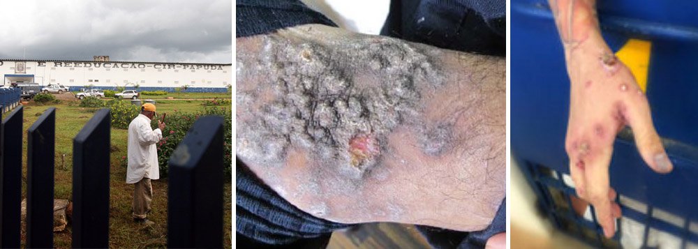 Dados da Secretaria de Segurança Pública apontam que o Complexo Penitenciário da Papuda, no Distrito Federal, tem 692 detentos contaminados por dois tipos de doença infecciosa que provocam feridas e fungos na pele - escabiose e o impetigo; o Ministério Público fez vistoria na Papuda em 27 de junho; o órgão disse que tomará "todas as medidas necessárias até que o problema de saúde seja resolvido"