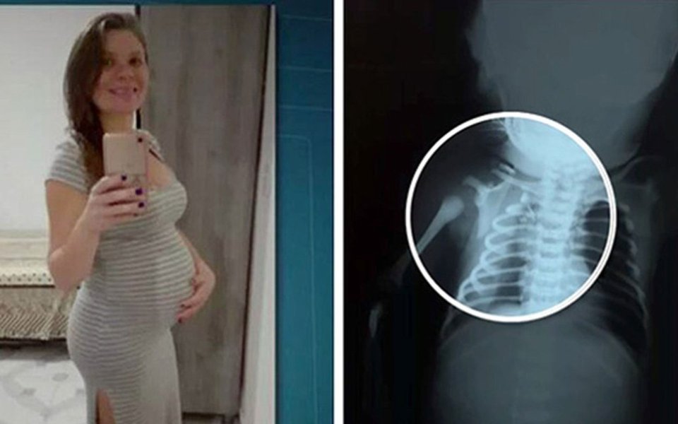 Apesar de grave, é estável o quadro de saúde do bebê Arthur que foi atingido por um tiro ainda dentro da barriga da mãe, Claudineia dos Santos Melo; o parto de emergência foi feito no Hospital Municipal Dr. Moacyr do Carmo, em Duque de Caxias, na região metropolitana do Rio, onde Claudineia teve alta; secretário estadual de Saúde, Luiz Antonio Teixeira Jr. disse que o Rio "vive numa verdadeira guerra urbana, esse ano já atendemos mais de 650 pessoas baleadas nos nossos hospitais e nossas equipes são preparadas para essa situação"