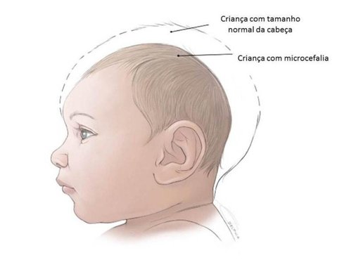 Dos 38 casos confirmados, nove mães tiveram Zika Vírus durante a gestação, estando os demais casos sob investigação. Dentre os casos apresentados, um óbito ocorreu em São José de Ribamar.