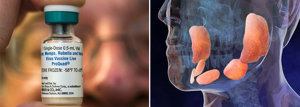 Do total, 737 ocorrências foram em moradores de Brasília — a maioria (467) em homens (o vírus pode infeccionar os testículos causando esterilidade); os dados são do Boletim Epidemiológico nº 2, divulgados pela Secretaria de Saúde; desde o início do ano, ocorreram 20 surtos isolados da doença em Brasília: 13 em escolas, três em residências, dois em complexos penitenciários e dois em outros locais não divulgados; em junho, pelo levantamento, houve 12