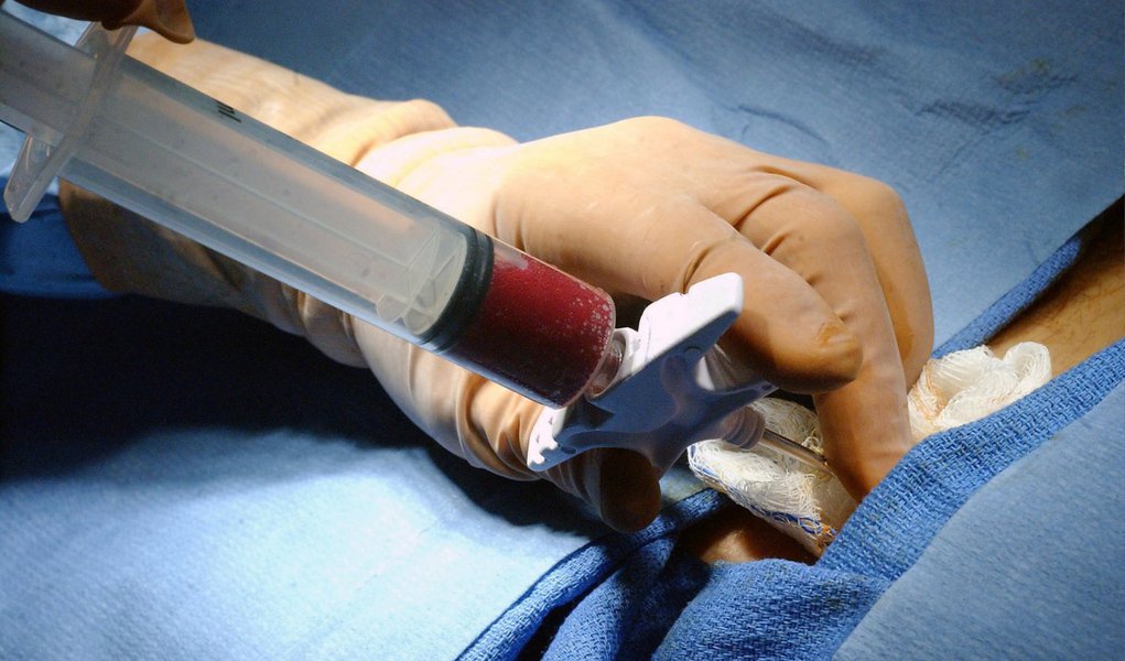 Nos últimos dez meses, o Distrito Federal realizou 30 transplantes autólogos de medula óssea (TMO) pelo Sistem Único de Saúde (SUS); até novembro do ano passado, pacientes que precisavam do transplante autólogo, tinham que ser encaminhados a outras unidades da Federação; procedimentos autólogos ocorrem quando as células retirada para transplante são do próprio paciente