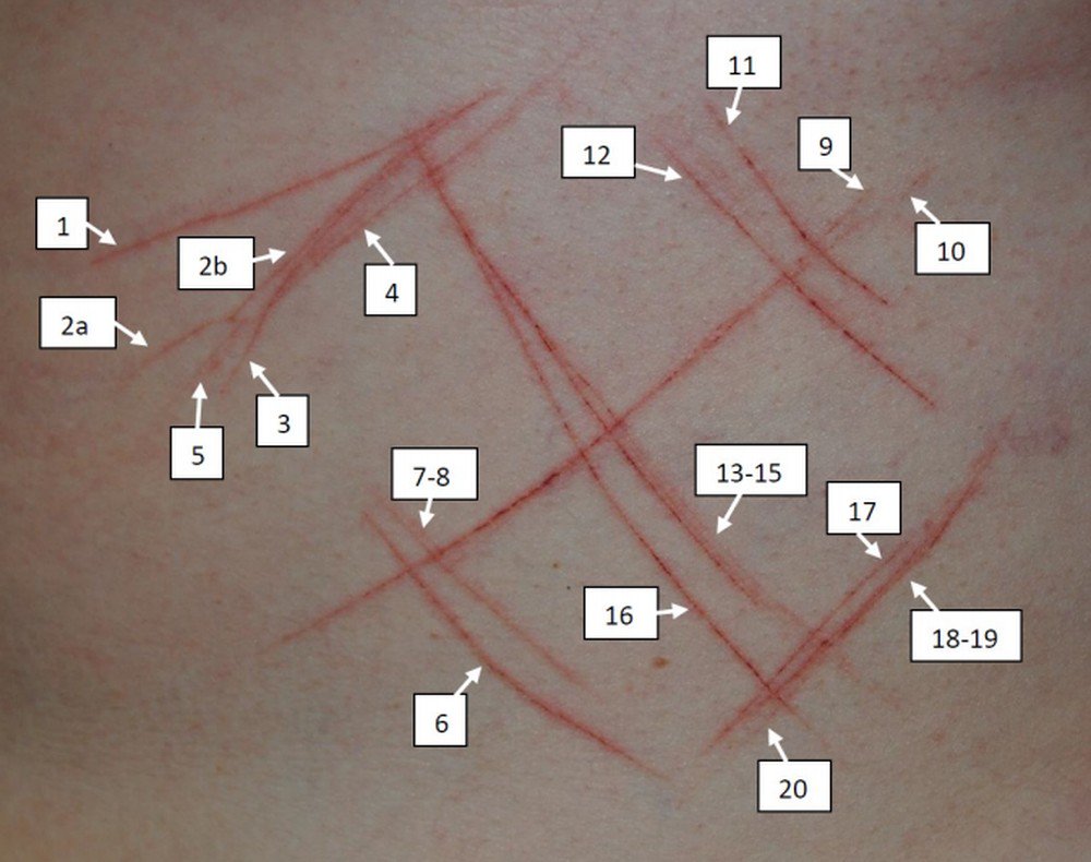 Defesa contesta conclusão de delegado sobre suástica em jovem