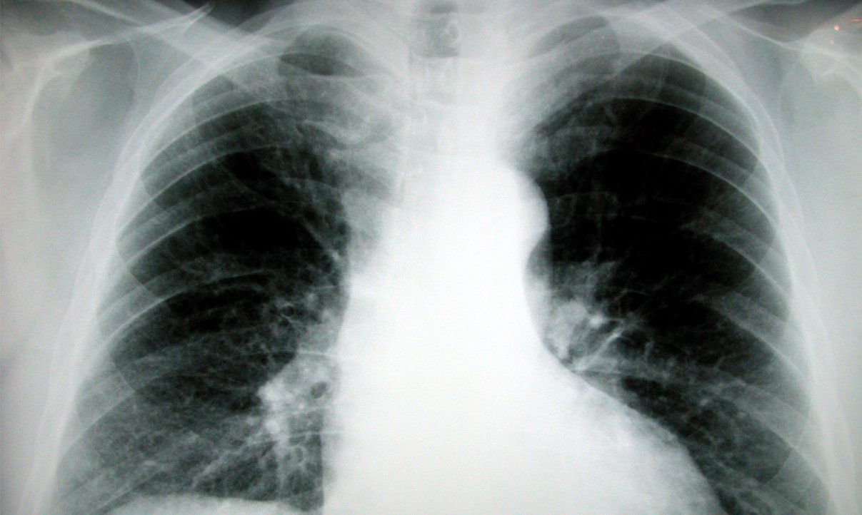 Bahia tem quase 5 mil casos de tuberculose por ano