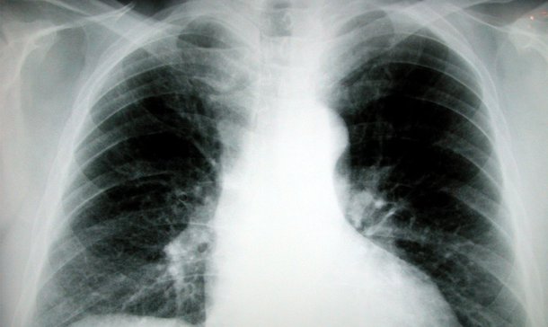 Bahia tem quase 5 mil casos de tuberculose por ano