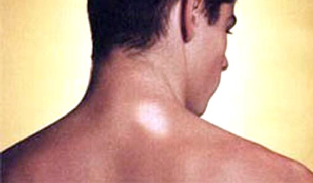 Hanseníase: PE recebe R$ 1,3 milhão para o combate 