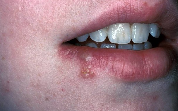 Herpes virou pandemia mundial. Metade da população está infectada
