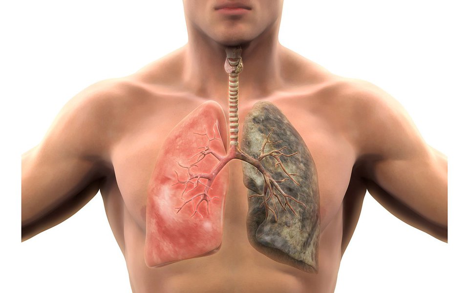 Enfizema. Muitos sofrem de doença pulmonar crônica obstrutiva (DPCO) sem sabê-lo