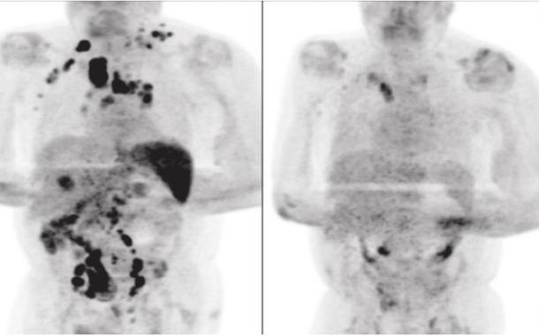 Remissão da doença antes e após diagnóstico de coronavírus