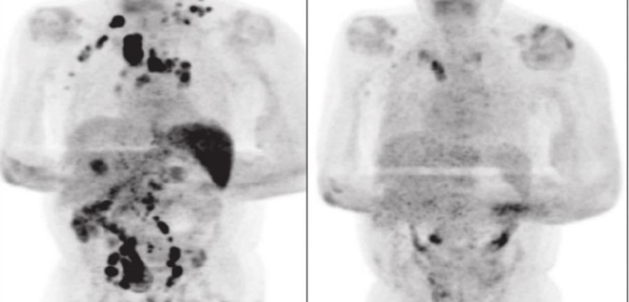 Remissão da doença antes e após diagnóstico de coronavírus
