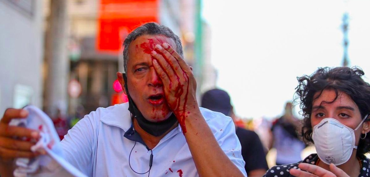 Daniel Campelo da Silva perdeu o olho após ser atingido no olho pela PM de Pernambuco