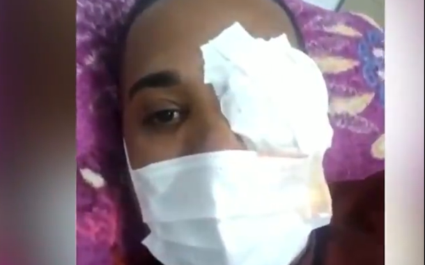 Desempregado Jonas Correia de França, 29 anos, é atingido por tiro pela PM no Recife e perdeu a visão do olho direito