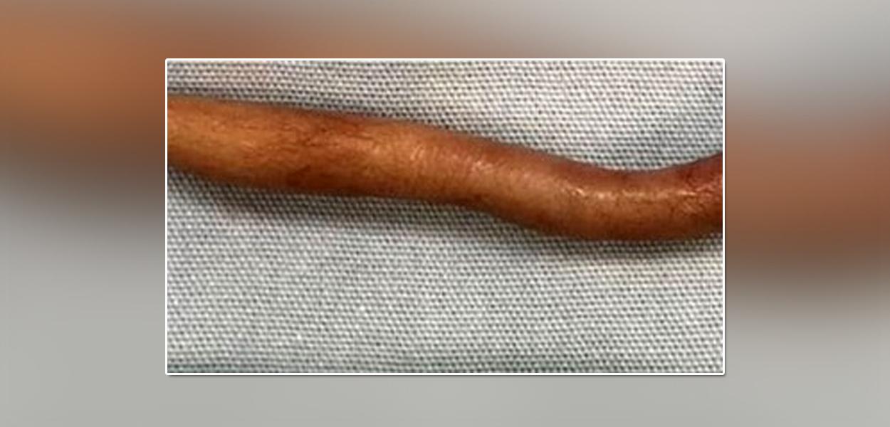 Bebê nasce com cauda de 6 centímetros