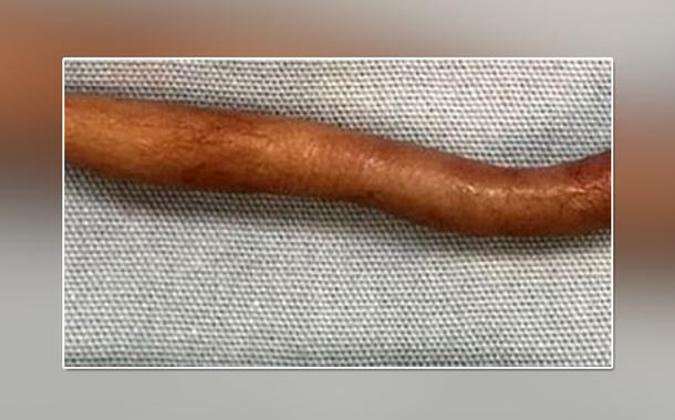 Bebê nasce com cauda de 6 centímetros